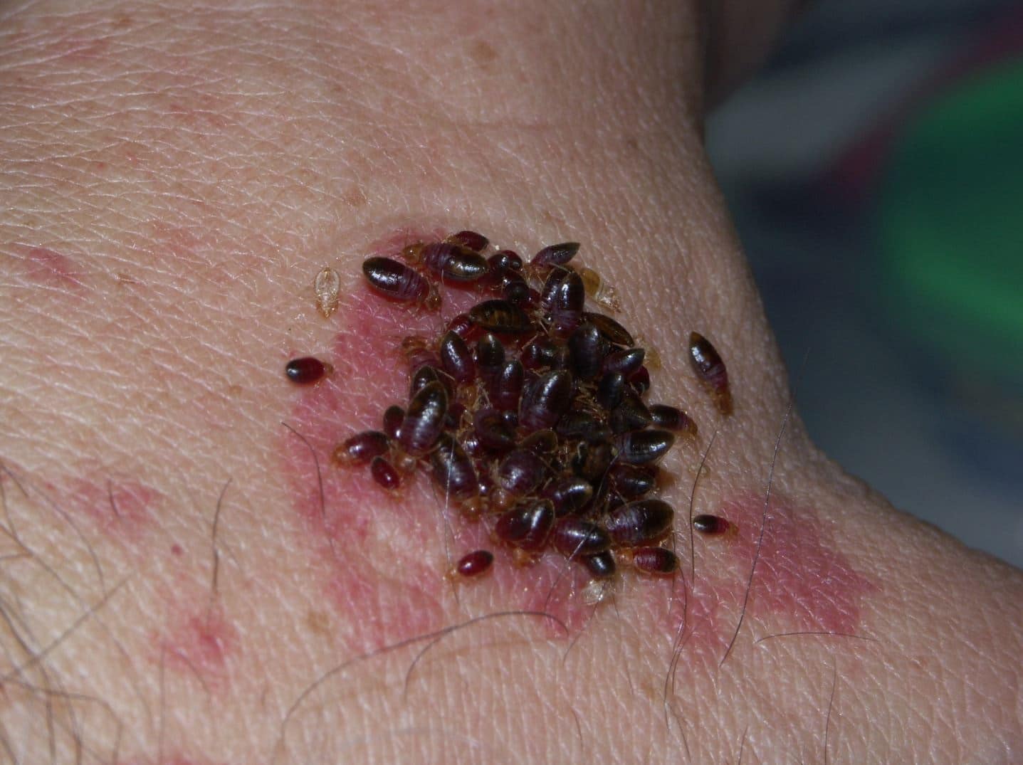 Where Do Bed Bugs Bite Common Bite Areas Explained